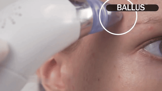 Derma Suction Pore Cleaning Device ✨ | Blackhead Remover Vacuum 🔋 USB Rechargeable 🌟